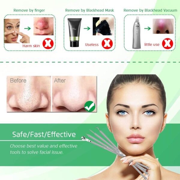 5PCS Blackhead Remover Comedone Extractor, Curved Blackhead Tweezers Kit, Professional Stainless Pimple Acne Blemish Removal Tools Kit - Image 2