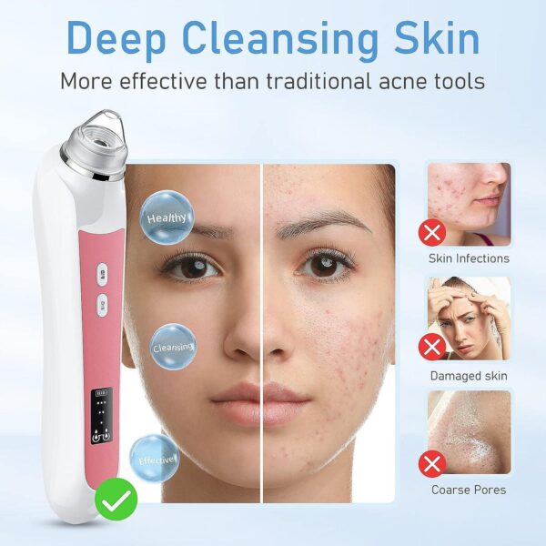 Blackhead Remover Vacuum, USB Interface Type Pore Vacuum, Black Head Extractions Tool with Camerafor, Men and Women Pore Cleaner, 3 Adjustment Modes and 6 Suction Heads(Light Pink) - Image 4