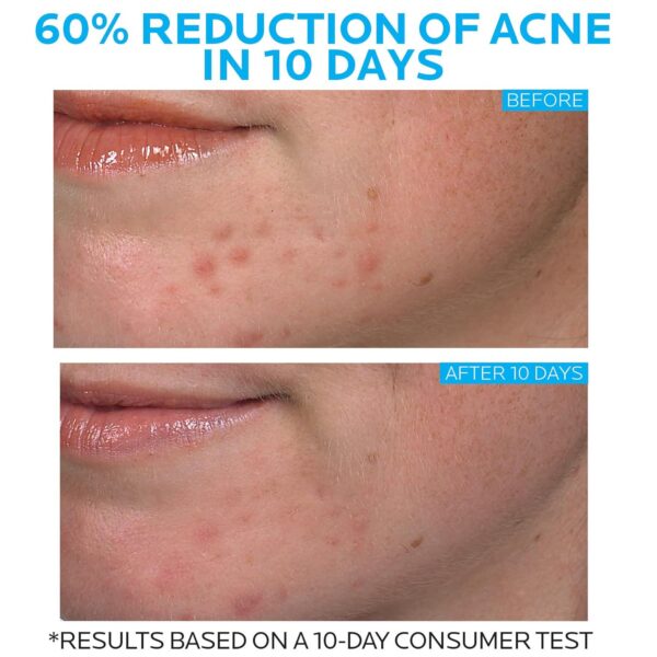 La Roche-Posay Effaclar Duo Dual Action Acne Spot Treatment Cream with Benzoyl Peroxide Acne Treatment for Acne and Blackheads, Lightweight Sheerness, Safe For Sensitive Skin - Image 3