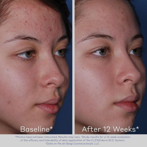 Obagi CLENZIderm M.D. Pore Therapy Exfoliating BHA Toner - Unclogs Pores with 2% Salicylic Acid Acne Treatment 5 oz - Image 5