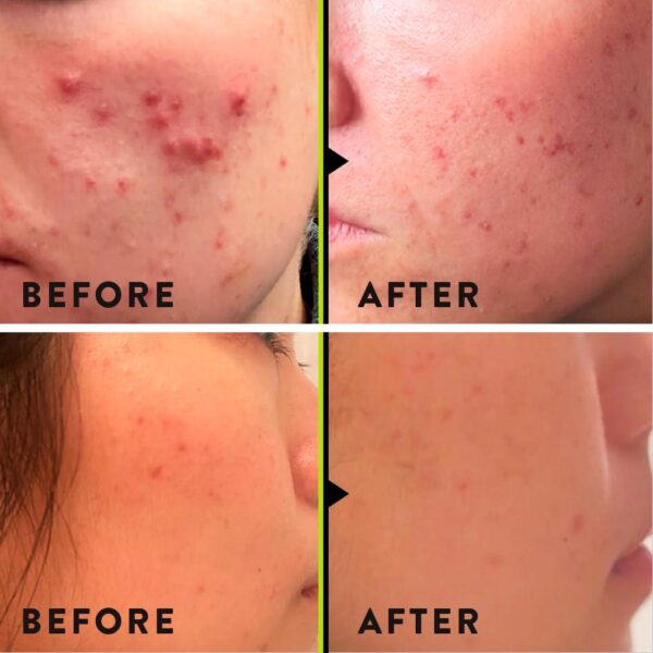 VERI Nitric Oxide + Salicylic Acid Clear Skin System (Peroxide-Free)- For Acne Prone Skin, Unclogs Pores, Clarifies Blemishes, Reduces Inflammation, Prevent Future Breakouts, 30 mL / 1 oz - Image 4