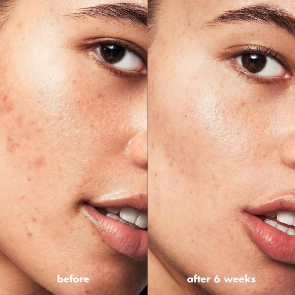 e.l.f. SKIN Blemish Breakthrough Acne Fighting Spot Gel, Roll-on For Treating Blemishes, Made With Salicylic Acid, Vegan and Cruelty-Free - Image 5